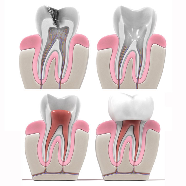 Root Canals - Dental Services